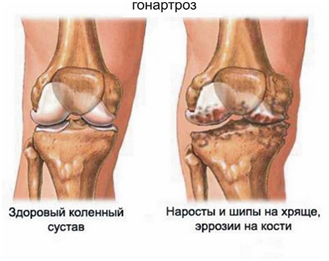 Почему при артрозе коленного сустава необходим компресс с имбирем на почки?